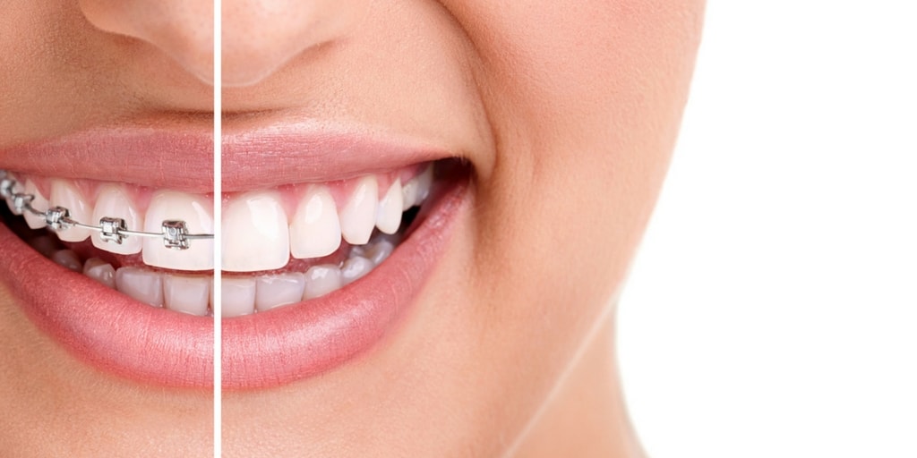 Top 4 intrebari pentru ortodont despre aparatul dentar metalic fix
